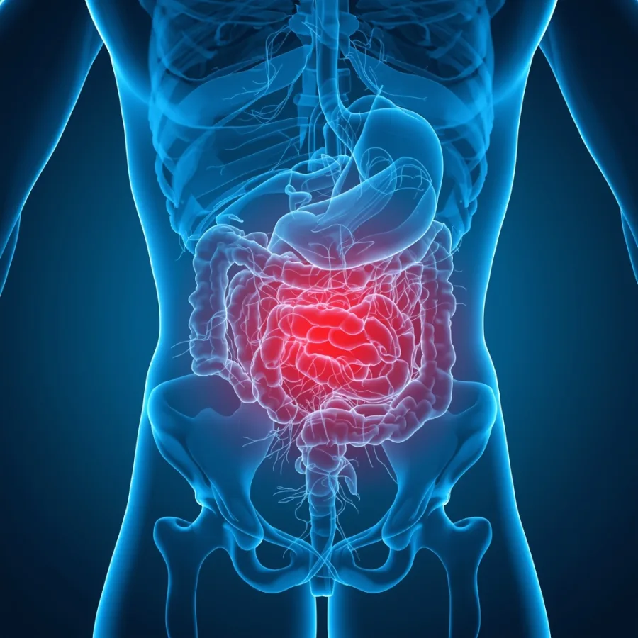 Hernia umbilical en Querétaro